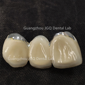 Laboratoire <span class=keywords><strong>Dentaire</strong></span> Oral Numérique 3D Imprimé Métal Céramique Pfm <span class=keywords><strong>Couronne</strong></span> et Bridges Chine <span class=keywords><strong>Prix</strong></span> - Product Image 4