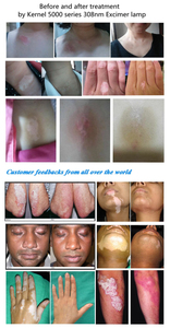 Système Excimer 308 nm, Appareil de Traitement du Vitiligo à Lumière Excimer Monomode 308 nm, Machine de Traitement du Vitiligo Excimer 308 nm - Product Image 6