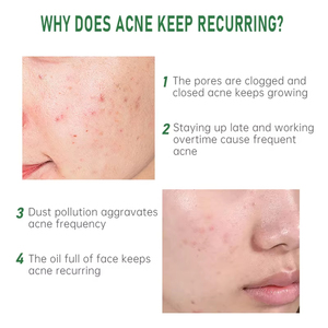 Chăm sóc da kiểm soát mụn trứng cá với axit hyaluronic Niacinamide & chiết xuất cây trà để làm sạch mặt & điều trị cân bằng dầu - Product Image 4