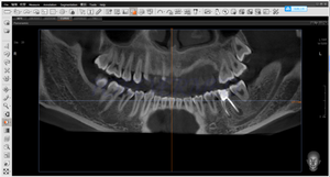 Macchina Radiografica Dentale Pano + Ceph + <span class=keywords><strong>CBCT</strong></span> Best Seller con Simulazione di Movimento dell'Impianto e Istruzioni Vocali - Product Image 5
