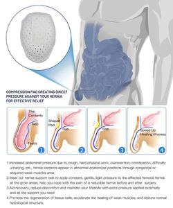 El nuevo soporte para <span class=keywords><strong>hernia</strong></span> inguinal cinturón para <span class=keywords><strong>hernia</strong></span> inguinal para hombres con almohadilla de compresión extraíble - Product Image 6