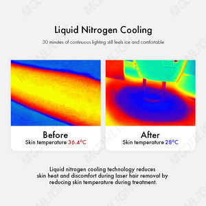 Sistema de depilación láser Alexander de doble longitud de onda de 755nm y 1064nm para una depilación efectiva - Product Image 3