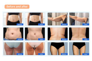 Excellent rapport qualité-prix : Appareil de remodelage corporel à 2 poignées avec rouleau à billes interne pour la réduction de la cellulite et l'élimination des graisses, machine de brûlage des graisses pour salon/spa - Product Image 6