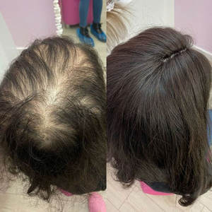 Peluca Médica de Cabello Humano 100% <span class=keywords><strong>Natural</strong></span> Negro de 14 Pulgadas con Encaje Frontal HD Suizo sin Procesar para Mujeres - Product Image 4