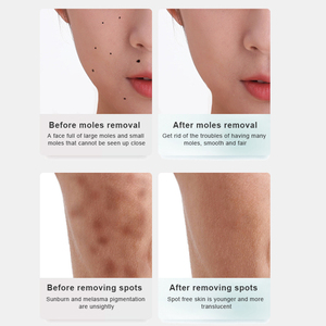 ปากกาลบไฝและหูดไฟฟ้าดูแลผิวไฟฟ้าเครื่องมือดูแลผิวหน้ากำจัดจุดด่างดำแบบมือถือ - Product Image 6