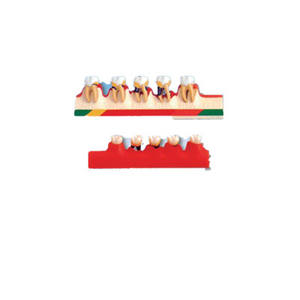 BIX-L1010 Bestaat Uit Vijf Delen Met In Totaal 15 Indicaties Parodontitis Classificatiemodel - Product Image 1