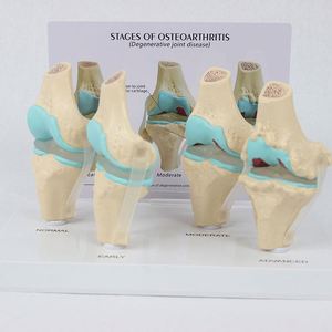 Modelo de articulación de rodilla humana de 4 etapas con tarjeta posterior, recurso didáctico de esqueleto de rodilla, modelo de articulación de rodilla con patología. - Product Image 2