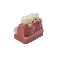 Modèle anatomique dentaire 4 fois plus grand pour implants, couronnes et bridges, en résine, pour l'analyse, la démonstration et la formation en dentisterie amovible