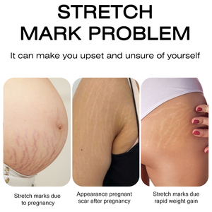 Crema Reparadora de Cicatrices, Tratamiento <span class=keywords><strong>para</strong></span> Manchas de Acné, Crema <span class=keywords><strong>para</strong></span> Eliminar Estrías, Suavizante, Reafirmante e Hidratante <span class=keywords><strong>para</strong></span> <span class=keywords><strong>el</strong></span> Cuidado de la Piel - Product Image 3