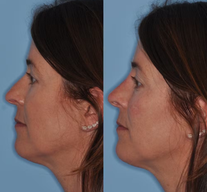Hereme Non-chirurgical 1ml 2ml 3ml 5ml Gel d'<span class=keywords><strong>acide</strong></span> <span class=keywords><strong>hyaluronique</strong></span> réticulé pour remodelage nasal, lifting facial et <span class=keywords><strong>injection</strong></span> de volume nasal - Product Image 4