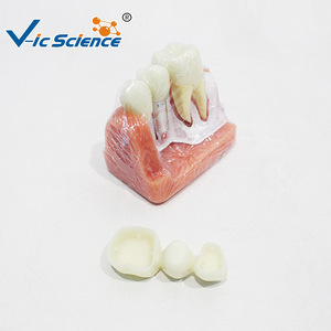 Modèle d'implant triple couronne en argent ; modèle de démonstration de communication dentaire médecin-patient - Product Image 1