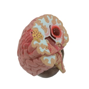 Modelos anatómicos cerebrales patológicos Hemorragia cerebral, tumores y modelo de enfermedad cerebral por accidente cerebrovascular - Product Image 1