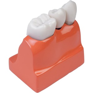 Modèle d'implant dentaire oral avec couronne et pont amovibles, adapté à la démonstration et à la formation des étudiants en dentisterie - Product Image 2