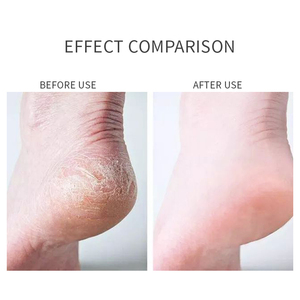 Gel d'élimination des callosités des pieds à l'acide salicylique végétalien pédicure spa pour les pieds exfoliant pour l'élimination des peaux mortes - Product Image 2