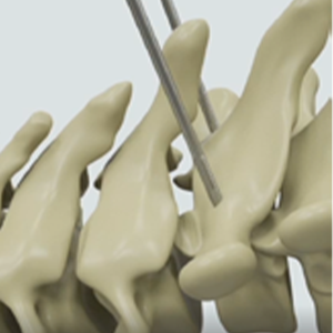 Fule 5.0mm Titanium Aanpasbaar Posterior Thoracolumbale Schroef-Stang Fixatie- en Fusiesysteem Klasse III met 5+ jaar garantie - Product Image 5