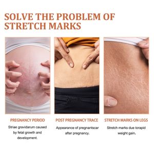 Meilleure vente Formule végétalienne Crème réparatrice pour les vergetures à action rapide, douce et non irritante pour une peau lisse du corps - Product Image 3