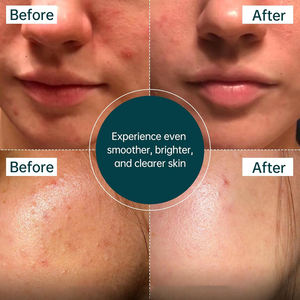 Sérum facial exfoliant liquide à l'acide salicylique BHA biologique, réduit l'excès de sébum, la texture irrégulière, 30 ml, pour l'acné, les points noirs, les pores dilatés - Product Image 5