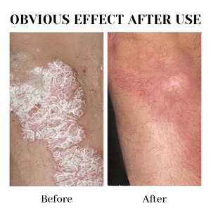 Crema de eccema de etiqueta privada OEM y ODM, crema corporal hidratante para el cuidado de la piel para la piel seca que pica - Product Image 4