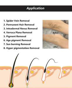 Épilation permanente d'enlèvement de veine d'araignée de machine d'électrolyse de vente directe d'usine - Product Image 4