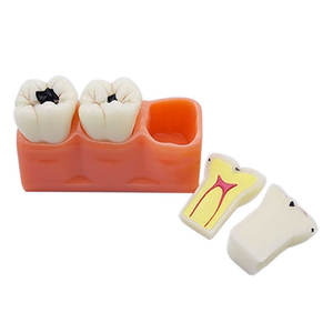 Estudio directo de fábrica <span class=keywords><strong>dentista</strong></span> anatómico oral cariado diente común enfermedades dentales modelo de comparación - Product Image 4