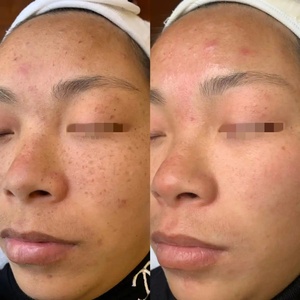 Crema Quita Manchas de Melasma, Elimina Pecas y Manchas Oscuras, Crema para Eliminar Pecas, Eliminador de Pigmentación para el Cuidado de la Piel del <span class=keywords><strong>Rostro</strong></span> - Product Image 2