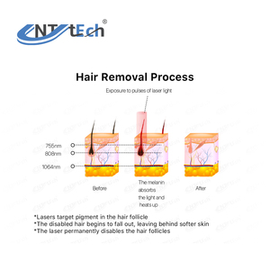 Trang Chủ Mini Cá Nhân Diode Laser Hair Removal Thiết Bị Với Hiệu Ứng Vĩnh Viễn - Product Image 6