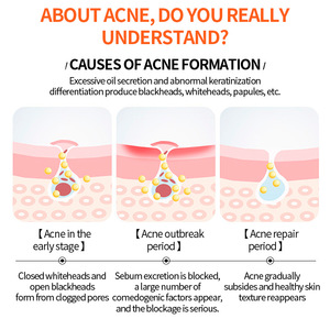 Patchs anti-acné en forme d'étoile 10 mm 10 pièces Traitement de l'acné pour adultes - Product Image 4