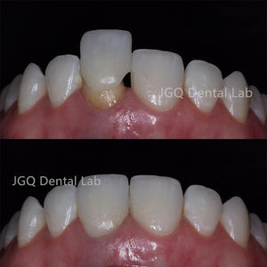 الأسنان إيماكس زركونيا تبييض الأسنان إيماكس وزركونيا القشرة مختبر الأسنان رخيصة الثمن - Product Image 3