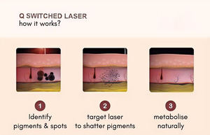 เลเซอร์ลบรอย<span class=keywords><strong>สัก</strong></span><span class=keywords><strong>คิ้ว</strong></span>532nm Q-Switch ขนาด1064 NM เลเซอร์ลอกรอยสักที่ได้รับการรับรองจาก CE สำหรับร้านเสริมสวย - Product Image 6