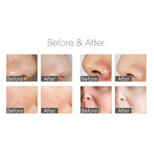 Thiết Bị Làm Đẹp Máy Lột Da Mặt Bằng Nước Bọt Nước Đá Nhỏ Mới - Product Image 4