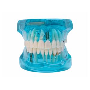 Modelo de Implante Dental, Modelo de Práctica de Restauración Dental - Product Image 1