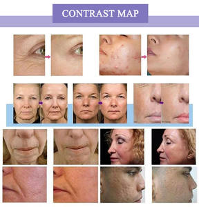 Máquina de limpieza facial Morph Golden Pins, dispositivo de cuidado de la piel con Jet Peel, antienvejecimiento, eliminación de arrugas y estrías, dispositivo de pie. - Product Image 2