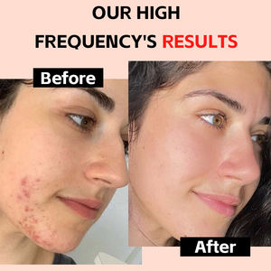 Nouvel appareil de soin du visage pour le lifting et le raffermissement, baguette de thérapie haute fréquence par électrothérapie, outil de soin de la peau pour le visage - Product Image 4