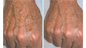 Lange Puls Ndyag Fiber Laser 1064nm Medische Kwaliteit Voor Professionele Haarverwijdering & Vasculaire Laesie Behandeling Op Donkere Huid - Product Image 5