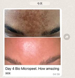 S Natural Spongilla Spicules Bio-microneedling Therapy Regenerate Collagen Elastin Green Peel Algae Peeling pour une cicatrice anti-âge - Product Image 4