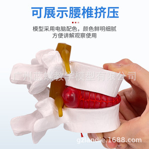 Simulation pédagogique du modèle de hernie discale lombaire humaine, démonstration de mesure de la pression vertébrale, vertébral - Product Image 5