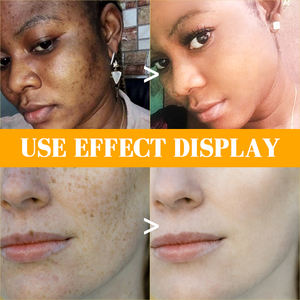 Crème anti-taches WANXI pour le <span class=keywords><strong>visage</strong></span> et le corps, traitement des taches brunes avec des ingrédients naturels pour le soin de la peau, mélasma, taches solaires - Product Image 5