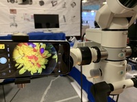 Adaptateur vidéo 8K pour smartphone pour microscope opératoire et lampe à fente