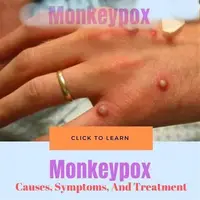 HCY 일회용 빠른 진단 Monkeypox 실시간 Pcr 키트 Monkeypox 빠른 테스트 키트