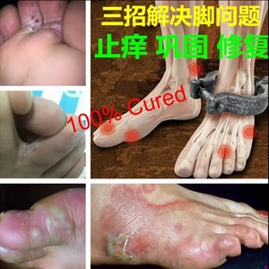 Crema exfoliante para pies de atletas, tratamiento de hongos para el olor de los pies y picaduras, pomada para celulitis, cuidado de los pies, envío gratis - Product Image 4