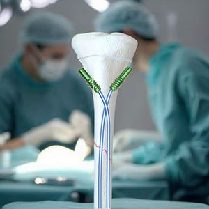 Orthopedische Elastische Intramedullaire Nagel Implantaat Elastische Nagel Orthopedisch Voor Kind Trauma Ziekenhuis Gebruik - Product Image 2