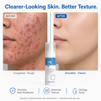 Gel anti-acné à 1 % de peroxyde de benzoyle, hydratant, contrôle du sébum, exfoliant, revitalisant pour la peau, traitement des taches, marque privée