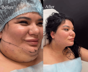 Lipolyse au laser diode endolifting 980 nm 1470 nm |   Injection de bouteille de citron |   Machine de perte de poids par injection amincissante - Product Image 3