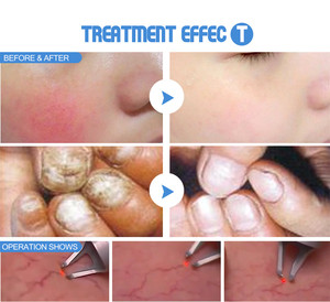 Mesin Laser 980nm untuk Penghapusan Varises dan Onikomikosis - Product Image 6