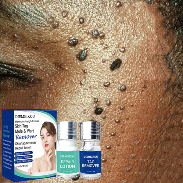 Безопасный, полностью натуральный, без боли, запатентованный высокочастотный лосьон для удаления пятен