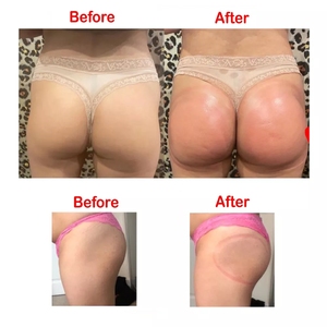 נייד שד הגדלת ישבן הרם באט רטט + ואקום + רחוק אינפרא אדום התחת הרמת מכונת כוסות רוח - Product Image 3