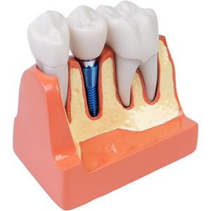 Modèle d'implant dentaire oral avec couronne et pont amovibles, adapté à la démonstration et à la formation des étudiants en dentisterie - Product Image 4