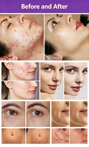 เครื่องเลเซอร์ CO2 แบบเศษส่วนคุณภาพสูง 10600 นาโนเมตร สำหรับการฟื้นฟูผิว ลดรอยแผลเป็นจากสิว และการฟื้นฟูช่องคลอด - Product Image 6