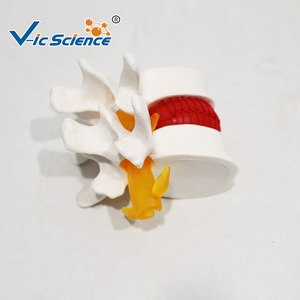 Modelo de demostración de hernia de disco lumbar, esqueleto vertebral espinal médico, material didáctico de patología, venta al por mayor desde - Product Image 3