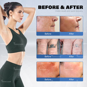 Perfectlaser 2025 mejor portátil 532 755 1064 1320nm Q Switched Laser Yag Pico Nd Yag máquina de eliminación de tatuajes con láser de picosegundos - Product Image 5